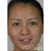 ps祛痘需要哪些工具