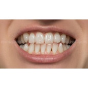 如何用ps修牙齿ps人像修图中美化牙齿简单教程